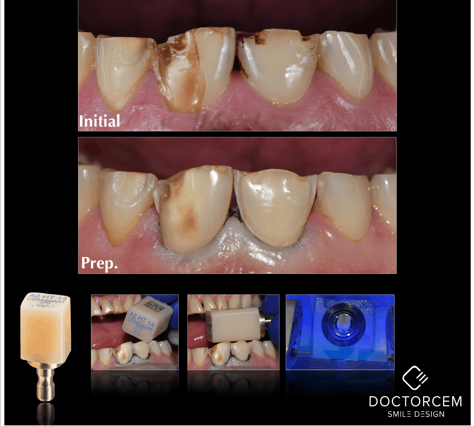 Cerec 1 Hour Dentistry